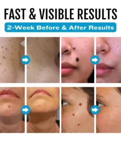 Natravor® SpotlessDerm Mole and Wart Laser Pen
