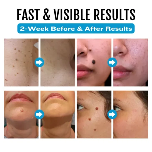 Natravor® SpotlessDerm Mole and Wart Laser Pen