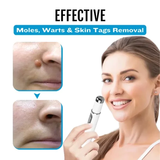 Natravor® SpotlessDerm Mole and Wart Laser Pen
