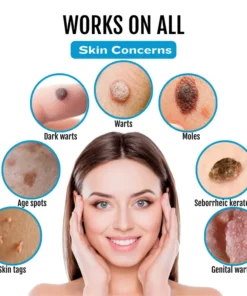 Natravor® SpotlessDerm Mole and Wart Laser Pen