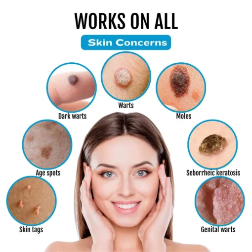 Natravor® SpotlessDerm Mole and Wart Laser Pen