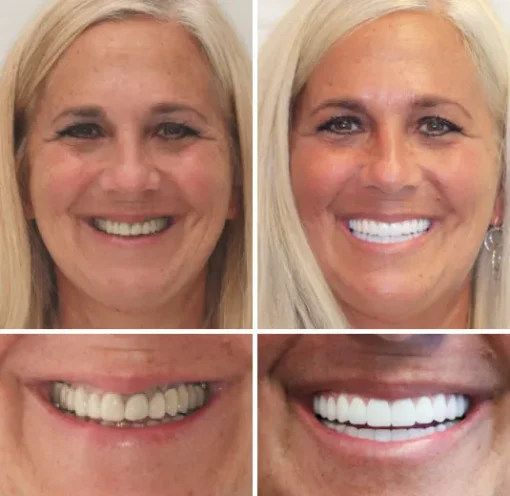 Natravor™- Dentadura Premium - Image 4