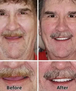 Natravor™-Advanced Custom-Fit Functional Dentures