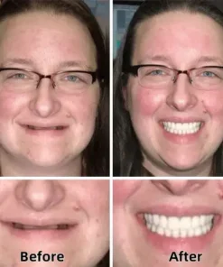 Natravor™-Advanced Custom-Fit Functional Dentures