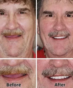 Natravor™-Advanced Custom-Fit Functional Dentures