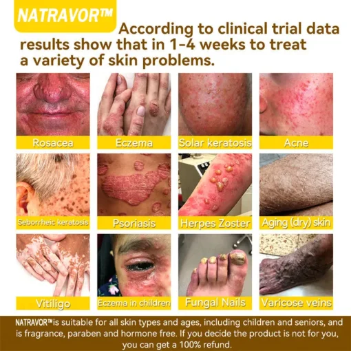 𝐍𝐚𝐭𝐫𝐚𝐯𝐨𝐫™ 𝐁𝐞𝐞 𝐕𝐞𝐧𝐨𝐦 Treatment Cream