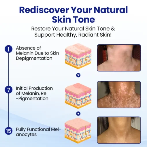 Natravor® Vitiligo Treatment Spray - Image 4