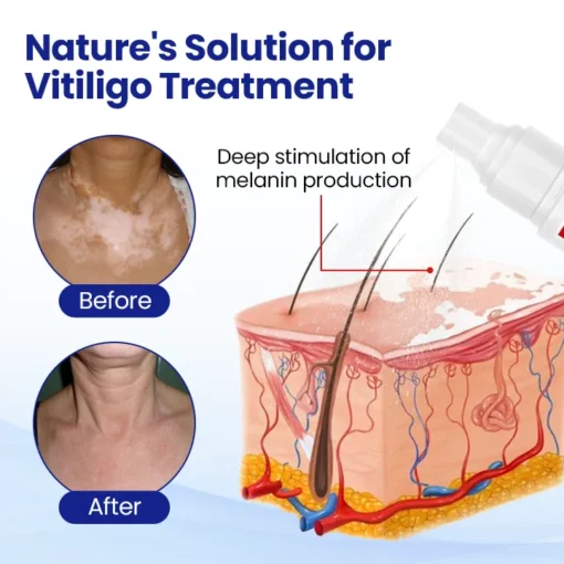 Natravor® Vitiligo Treatment Spray - Image 2