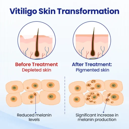 Natravor® Vitiligo Treatment Spray - Image 3