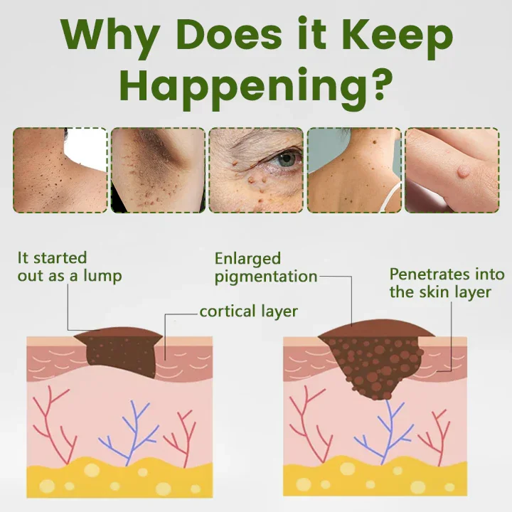 NATRAVOR® ThujaClear Botanical Wart Cream - Image 2