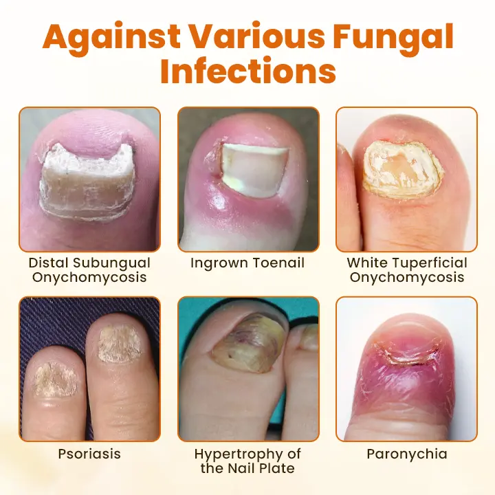 NATRAVOR® FungiBee Advanced Nail Repair Spray