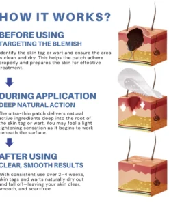 NATRAVOR® Moles & Warts Removing Skin Tag Patch