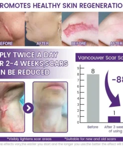 Natravor® ReGenScar Stem Cell Scar Gel