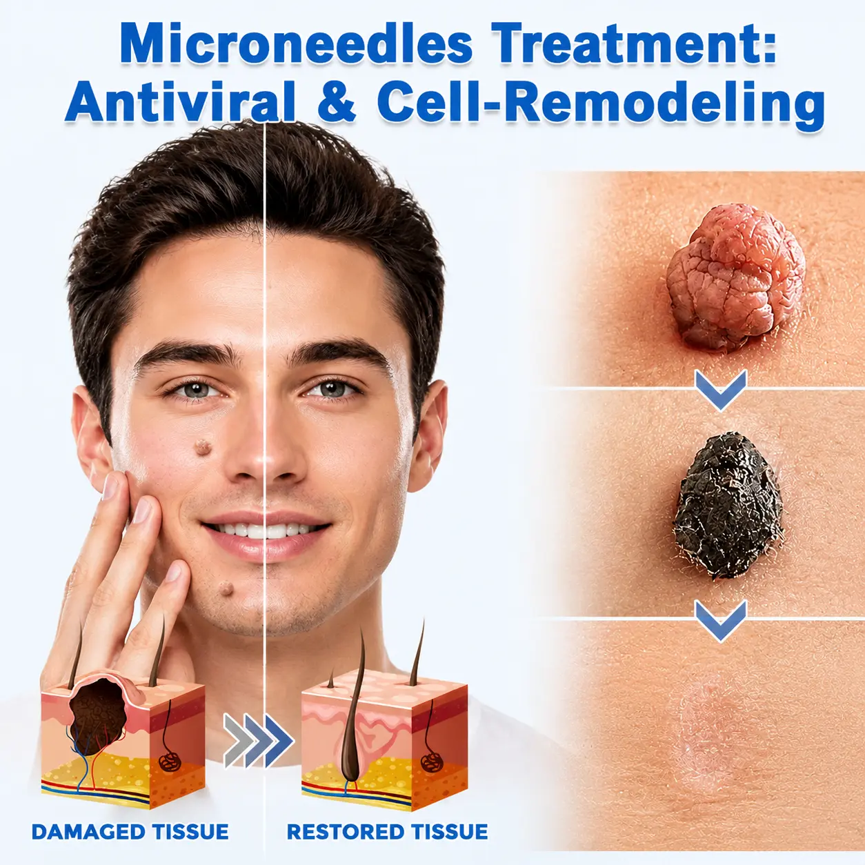 Natrvor® 2-in-1 Microneedle & Hydrocolloid Patch