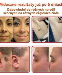 Natrvor® Patches for removing warts and moles using plant-based micro-needles