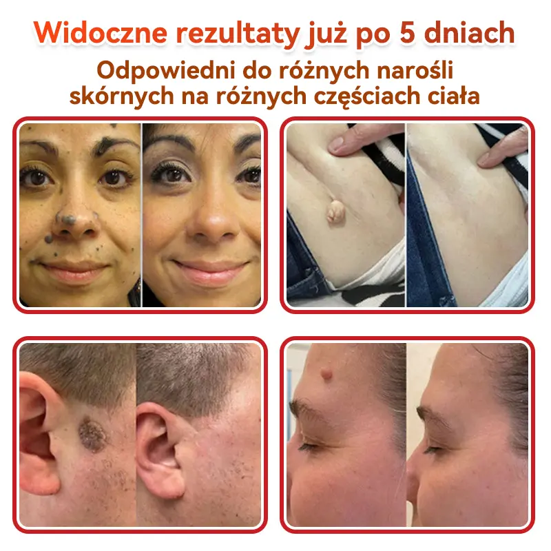 Natrvor® Patches for removing warts and moles using plant-based micro-needles