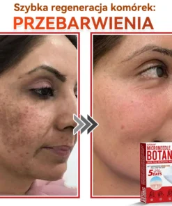 Natrvor® Patches for removing warts and moles using plant-based micro-needles