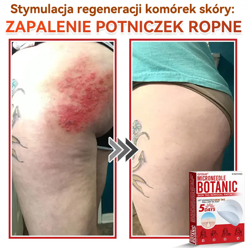 Natrvor® Patches for removing warts and moles using plant-based micro-needles