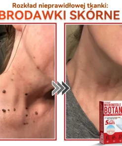 Natrvor® Patches for removing warts and moles using plant-based micro-needles