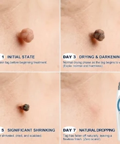 Natravor® Skin Tag & Spot Appearance Support Pen