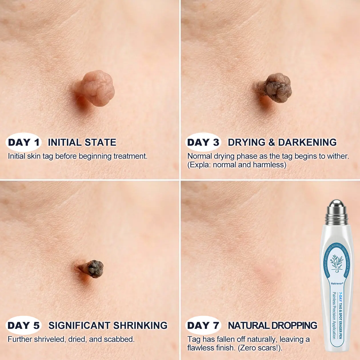 Natravor® Skin Tag & Spot Appearance Support Pen