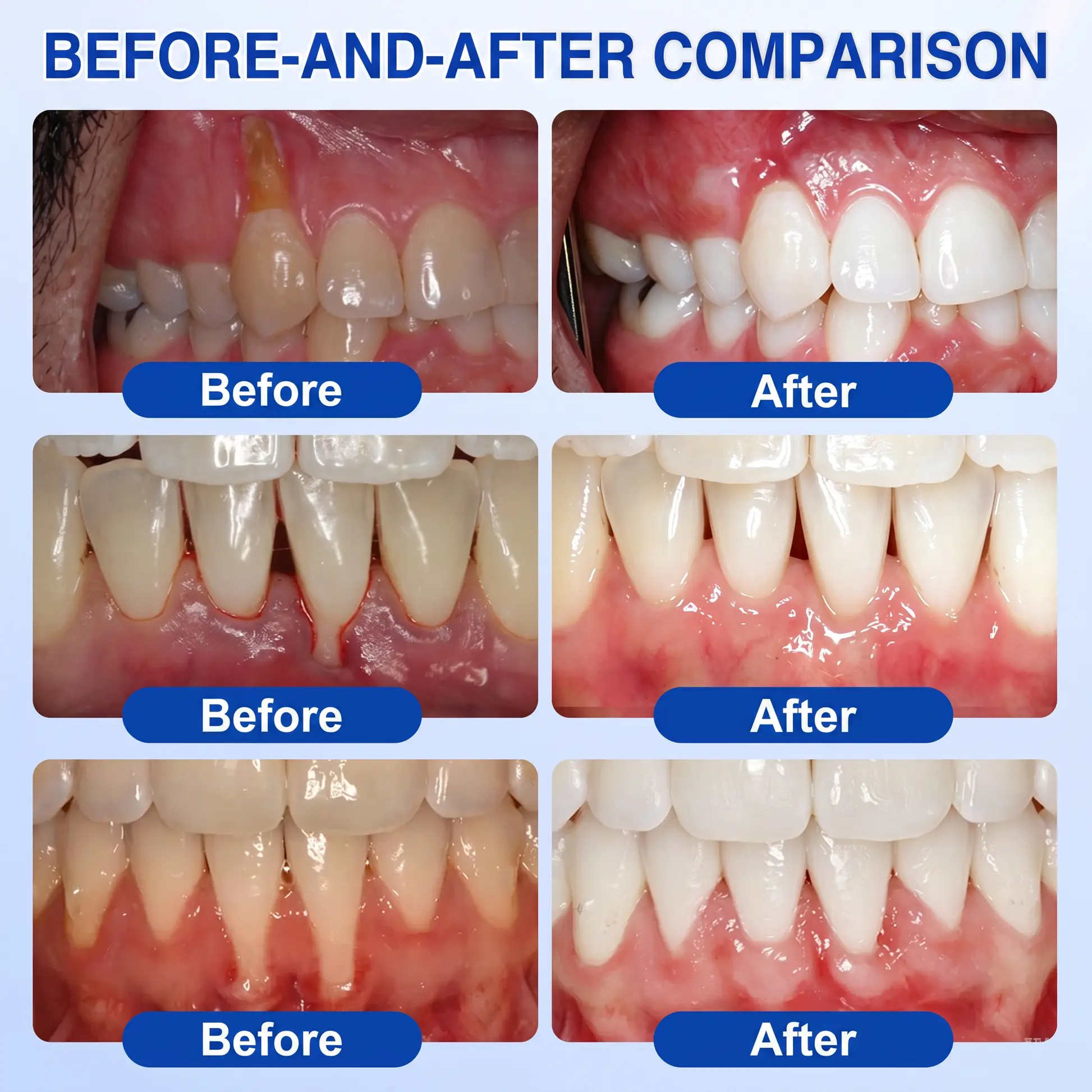NATRAVOR® GumRevive Periodontal Repair Gel