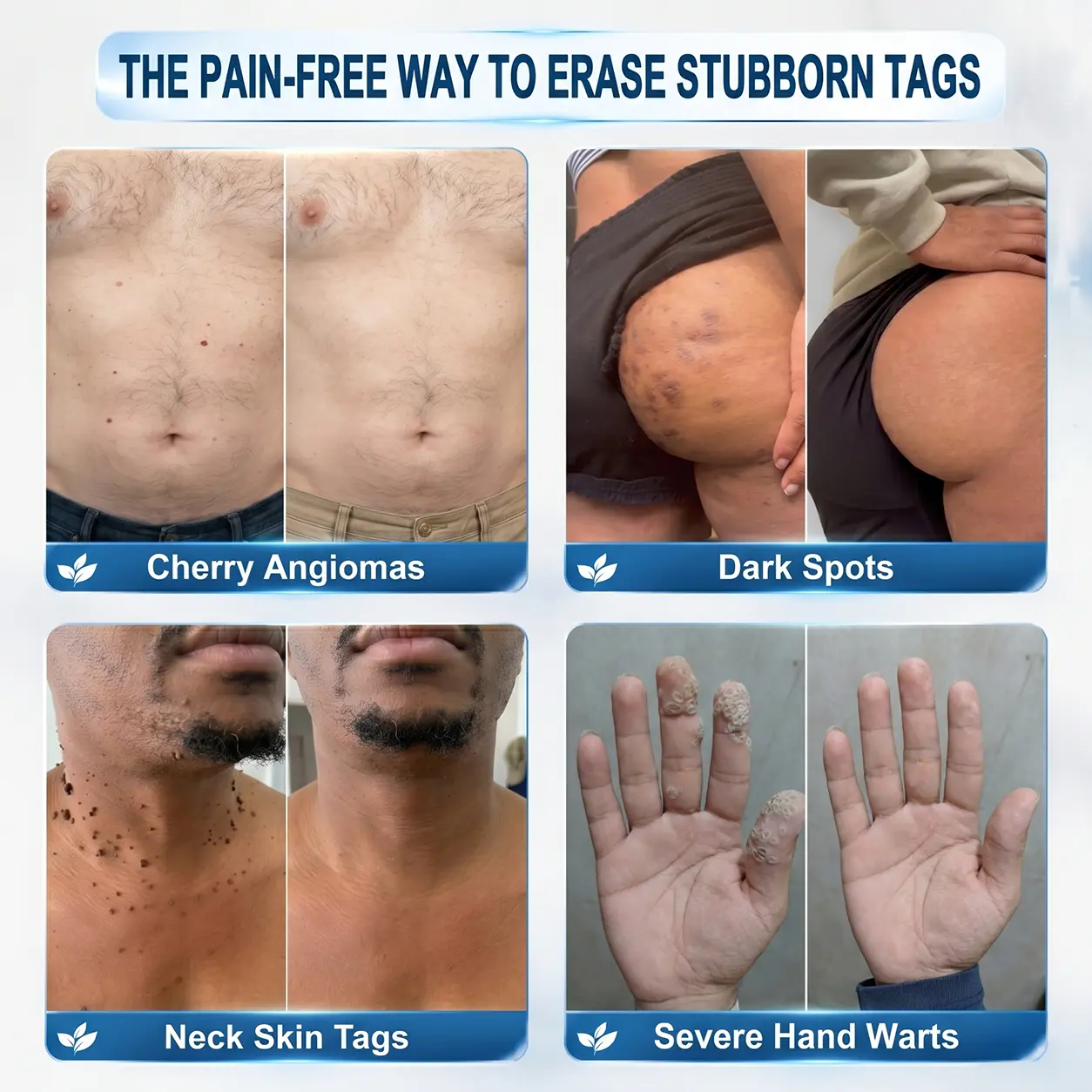 Natravor® 7-Day Cream for Skin Tags & Spots