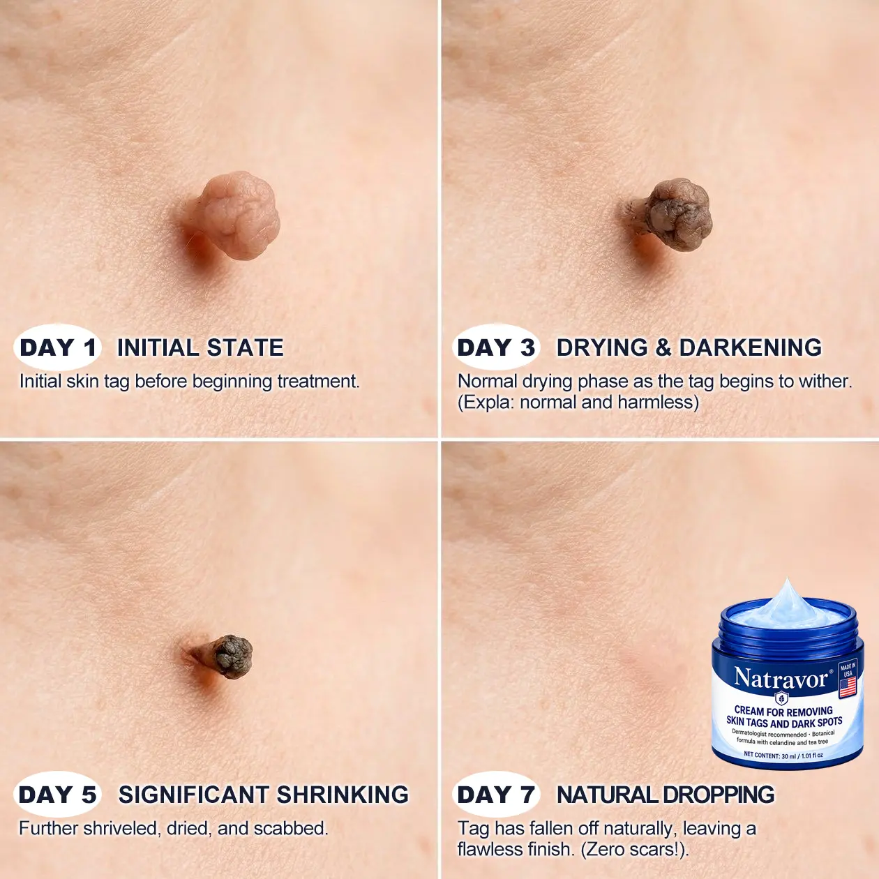 Natravor® 7-Day Cream for Skin Tags & Spots