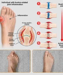 Natravor® Relief Botanical Bunion Comfort Patcht