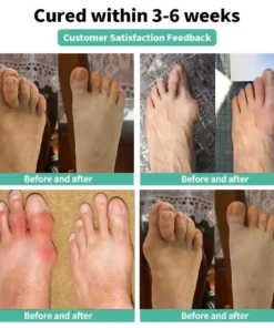 Natravor® Relief Botanical Bunion Comfort Patcht