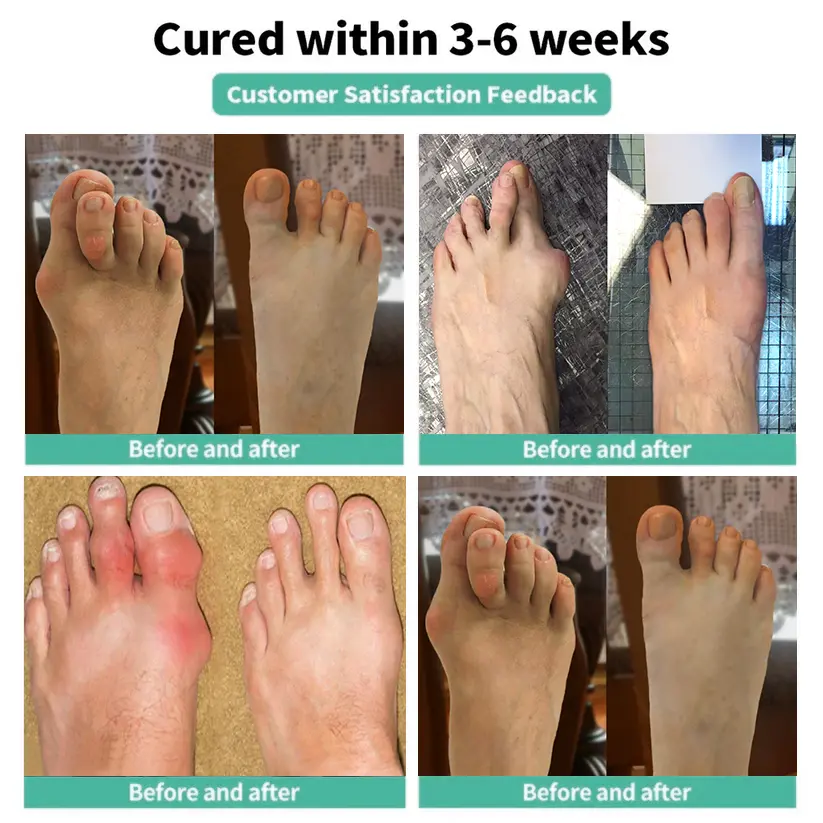 Natravor® Relief Botanical Bunion Comfort Patcht