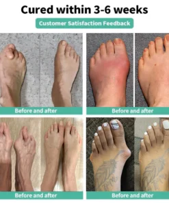 Natravor® Relief Botanical Bunion Comfort Patcht