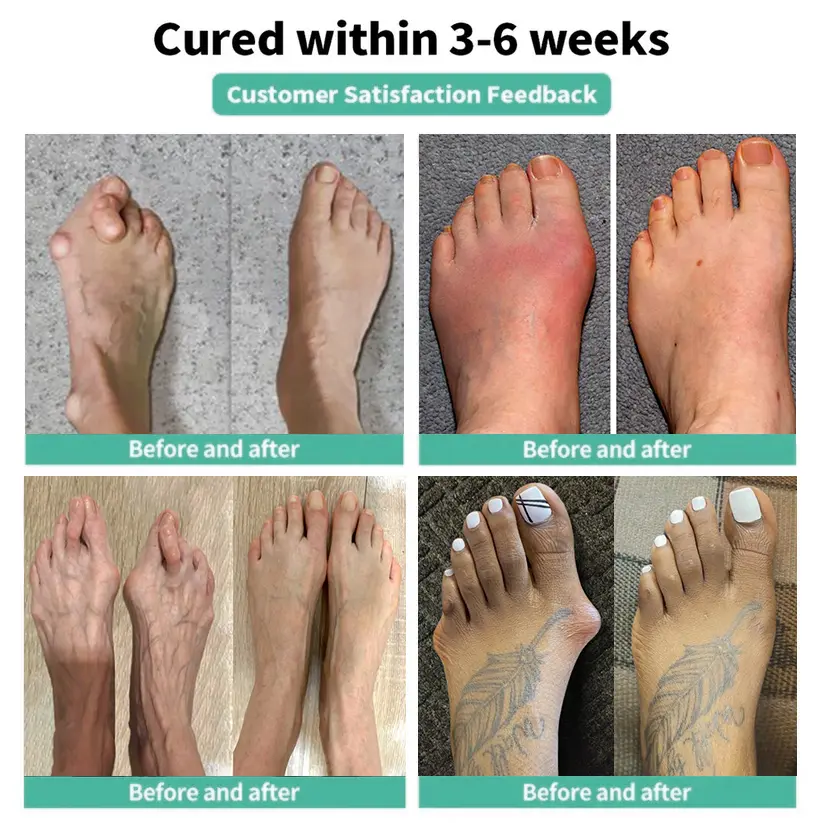 Natravor® Relief Botanical Bunion Comfort Patcht