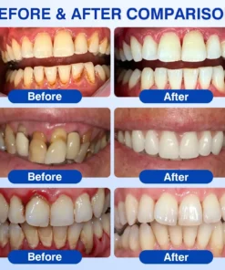 Natravor® Thismile NH-10 Toothpaste Serum for Enamel & Gum – Advanced Therapy