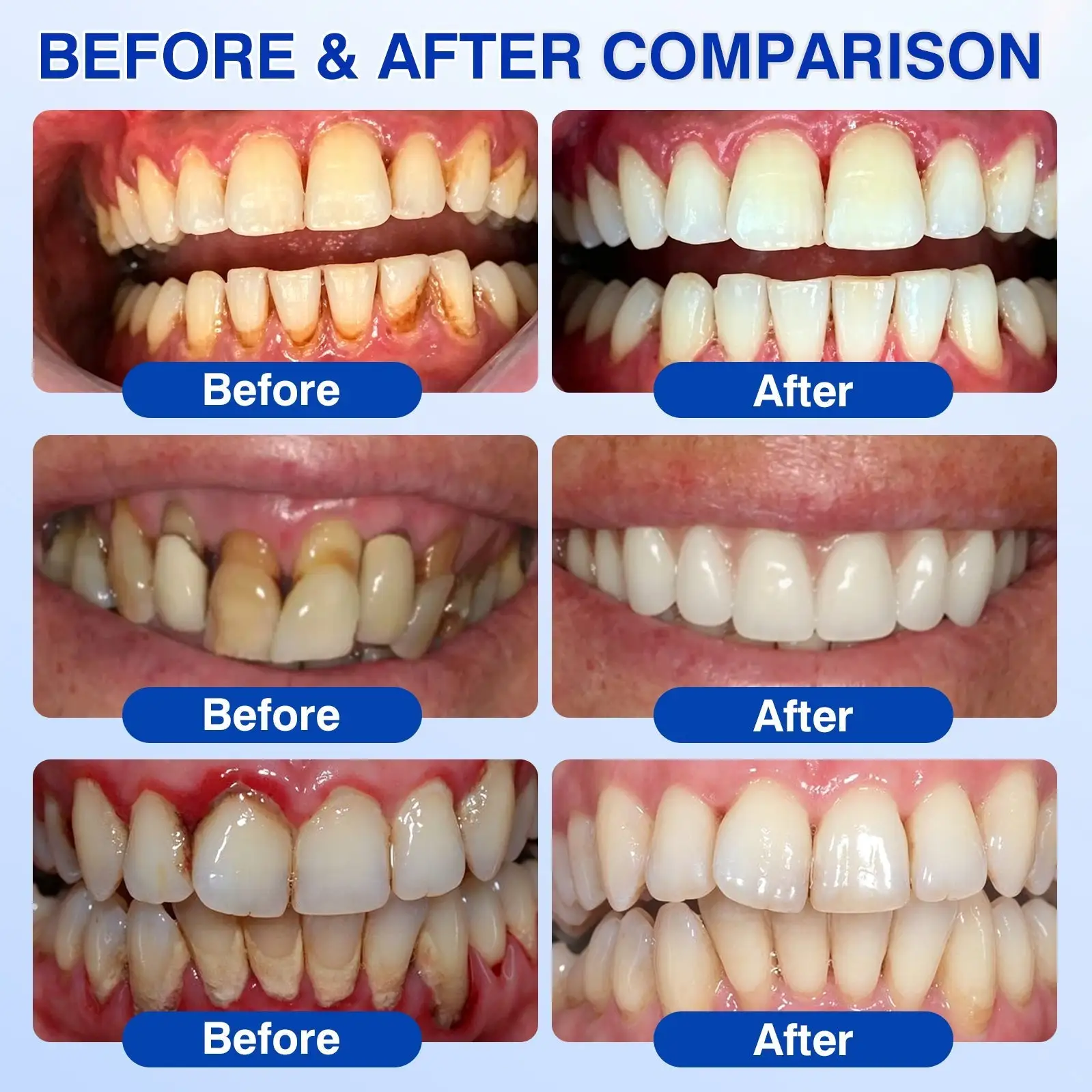 Natravor® Thismile NH-10 Toothpaste Serum for Enamel & Gum – Advanced Therapy